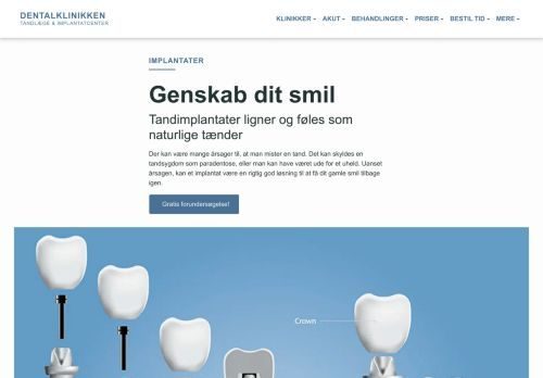 Forsiden af Erstat manglende tænder med implantater